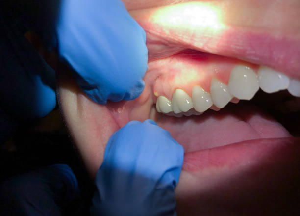 Best Knocked-Out Tooth (Avulsed Tooth) Treatment in Buena Vista, MI